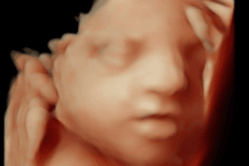 Ultrasound