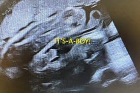 Ultrasound