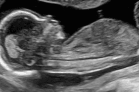 Ultrasound